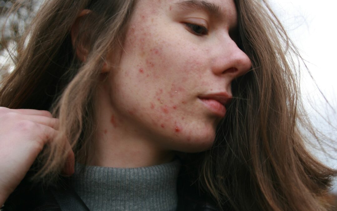 Can Acne Facials Help Blemishes from Winter Masks?